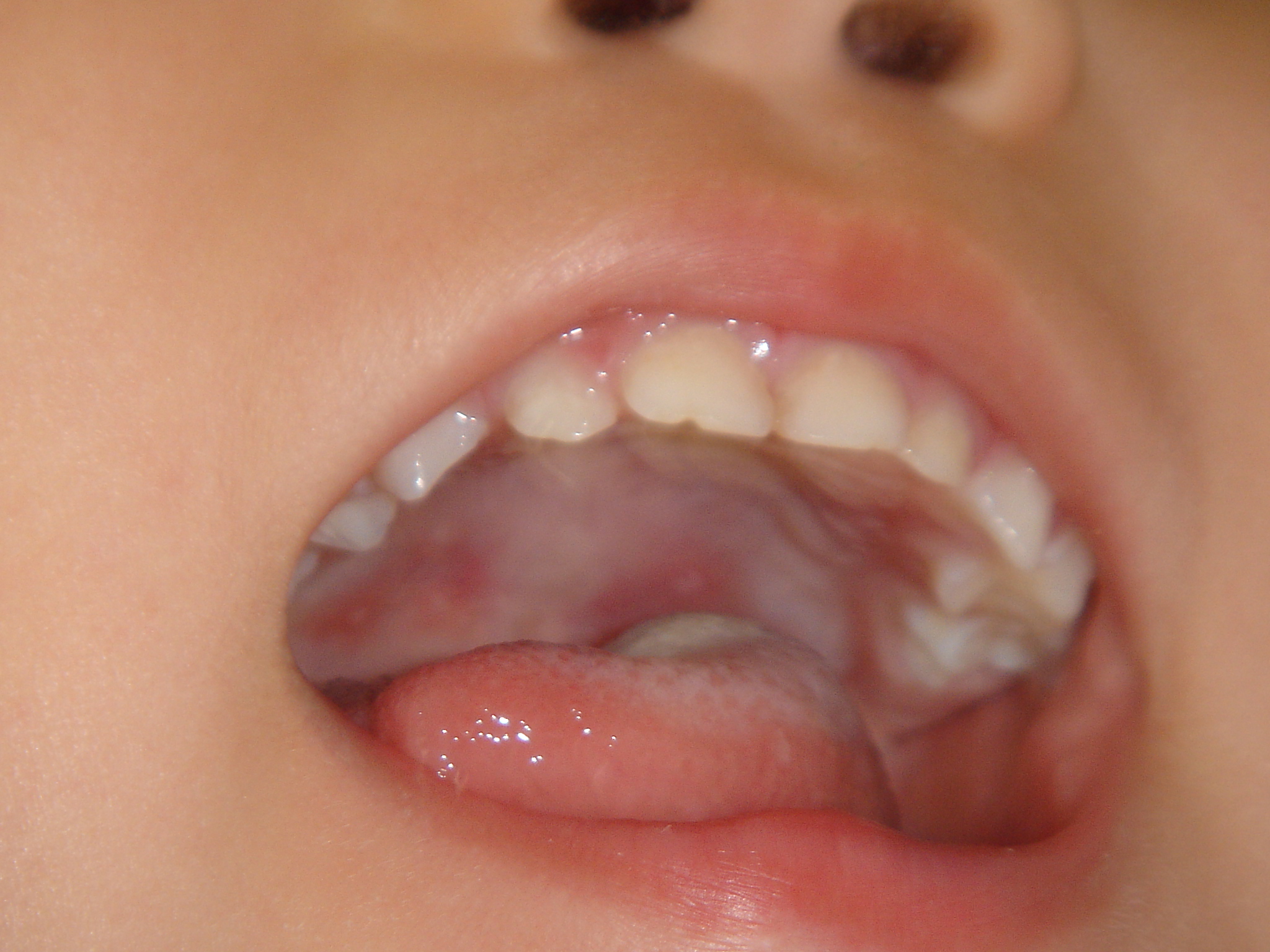 上 赤ちゃん 口の中 白い 124082赤ちゃん 口の中 白い 歯茎